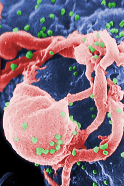 Többen HIV-vel fertőződtek meg egy amerikai gyógyfürdő kozmetikai kezelései során